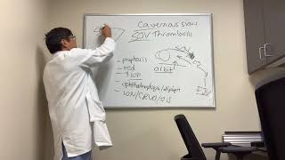 Cavernous Sinus and Superior Ophthalmic Vein Thrombosis [upl. by Ayikahs]