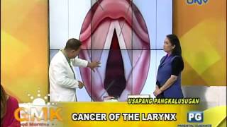 Cancer of the Larynx [upl. by Emalia]