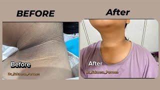 Acanthosis Nigricans Treatment Before And After ❤️👍DrSakeenaparveen [upl. by Nosak]