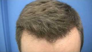 Hair Transplant  1489 Grafts  Dr Wong [upl. by Edsel]