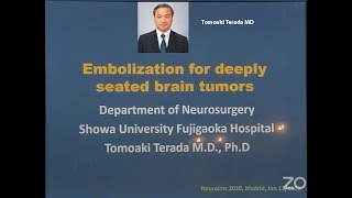 Embolization for deeply seated Brain Tumors [upl. by Yelyac]