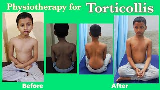 Torticollis Physiotherapy treatmentWry Neck Exercises Torticollis stretching exercises [upl. by Vanya]