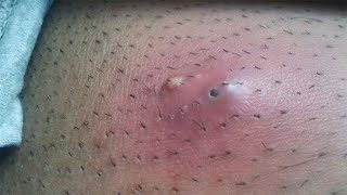 Ingrown hair under arm pit‼️ so many hairs trapped 😱 [upl. by Arrat]