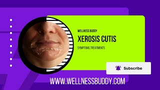 Xerosis Cutis Severe Dry Skin Calluses and Fissures [upl. by Eskill373]