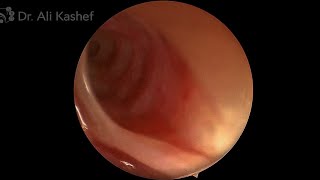 Nasolacrimal duct opening  Hasner’s Valve using 70 degree Endoscope transnasal [upl. by Akselav]