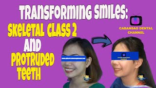 skeletal Class 2 with prominent front teeth transforming smiles by braces 2024 [upl. by Motteo]