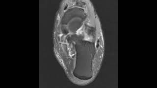 Posterior tibial tendon tear spring ligament tear and sinus tarsi inflammation [upl. by Dedrick923]