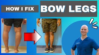 The ONLY way to Fix Bow Legs  Get the Facts [upl. by Lauren]