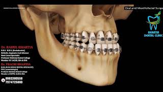 Jaw Advancement Surgery Explained Bilateral Sagittal Split Osteotomy [upl. by Orella]