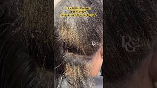 How to remove lice from hairhow to treat lice amp nitslice removallice treatment in Coimbatorelice [upl. by Eidda]