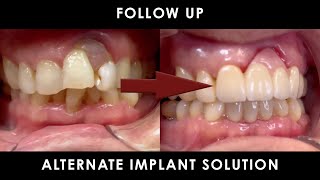 Following Up on an Alternate Implant Solution After Tooth Extraction [upl. by Mimi]