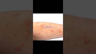 How to Quickly Identify Scabies Symptoms  Scabies Health tips Home remedies SkinCare [upl. by Enihpad]