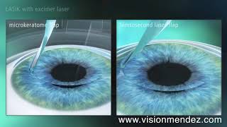 LASIK vs FEMTOLASIK [upl. by Noitsuj]