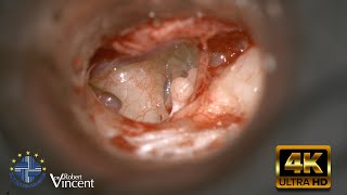 Traumatic Incus Dislocation  Total Ossicular Reconstruction  Malleus Relocation amp Silastic Banding [upl. by Ordnajela]