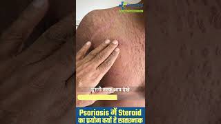 Full Body Psoriasis के इलाज में Steroids  Psoriasis Treatment India shorts psoriasistreatment [upl. by Hilaria]