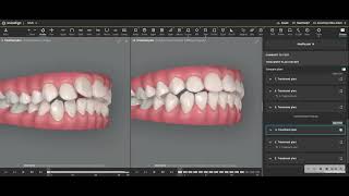 Severe Overjet Reduction with Invisalign and IPR [upl. by Ardnuassak]