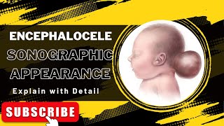 Encephalocele explain the sonographic appearance and How it shows on ultrasound [upl. by Atsirhc]