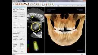 3D Implant Planning with the Invivo5 Software [upl. by Hathcock57]