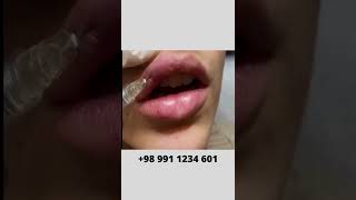 How to Fill In Your Lips  Lip Filler Injection [upl. by Polash460]