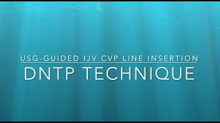 CVP line Insertion using DNTP technique Ultrasound guided central line insertion [upl. by Gerianne]