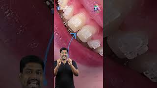 கிளிபுக்கு பிறகும் இடைவெளி இருக்குமா  Incisal embrasure  DrKarthikeyan  Denta Kings [upl. by Golter]