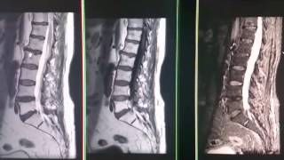 Resonancia magnetica de columna lumbar y columna dorsal [upl. by Otero858]