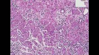 Histopathology Esophagus Herpes esophagitis [upl. by Hyacinthe]