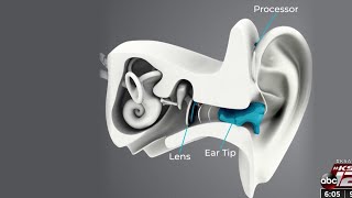 New device for hearing loss acts like a contact lens for the ear [upl. by Sewole]