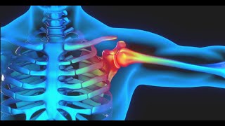 Physiotherapy Treatment Plan for Patient with Acromioclavicular Joint Dislocation A Case Report [upl. by Ocirrej]