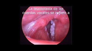 LEUCOPLASIA DE CUERDAS VOCALES⁣⁣  VOCAL FOLD LEUKOPLASIA [upl. by Corrina]