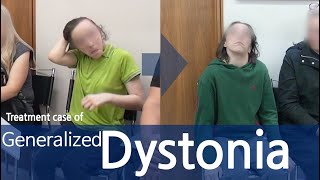 Dystonia  Generalized Dystonia  사경증  전신사경증 [upl. by Serolod]