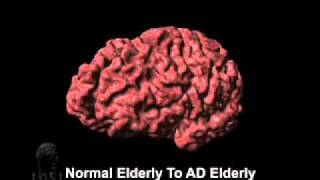 Cortical Atrophy Associated with Alzheimers Disease [upl. by Card]