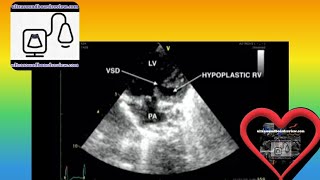 Hypoplastic Right Heart Syndrome [upl. by Anahsohs]