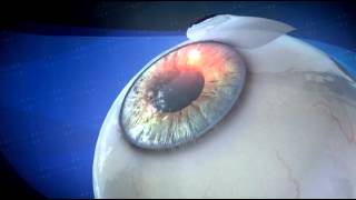 Lasik Eye Surgery  3D Medical Animation  ABP © [upl. by Scarface]