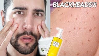 Testing An Esthetician Approved Oil Cleansing Routine  OIL PLUGS BLACKHEADS ✖ James Welsh [upl. by Acsehcnarf]