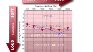 How to Read an Audiogram [upl. by Atirhs]