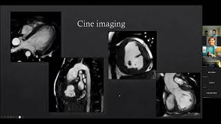 Magnetic Resonance Imaging of the Fontan Circulation  Sunil J Ghelani MD [upl. by Justine]