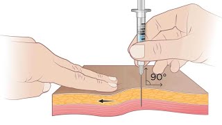 z track im injection gluteal z track im injection deltoid z track method im injection [upl. by Leumhs]