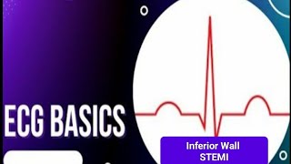 ECG Basics  Inferior wall STEMI [upl. by Anuaek813]