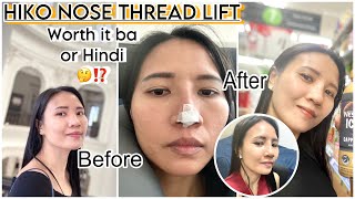 HIKO NOSE THREAD LIFT [upl. by Derby400]