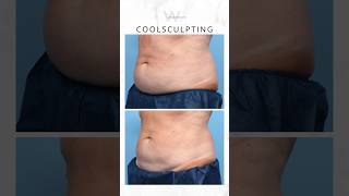 CoolSculpting before and after body contouring results to remove stubborn fat bodysculpting [upl. by Daenis]