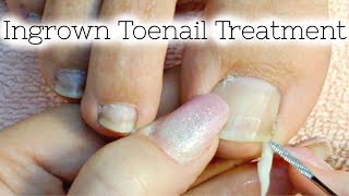 Pedicure Tutorial Ingrown Toenail Treatment At Home How to Recut Nail Groove to Eliminate Pain [upl. by Germain]