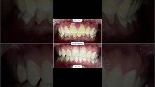 31yrs old IT PROFESSIONAL suffering with high BP coz of pyorrhoea shorts viralvideo dental gums [upl. by Feola482]