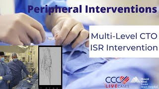 MultiLevel CTO ISR Intervention [upl. by Ailuy747]