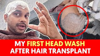 How To Wash Your Hair After Hair Transplant  Hair Transplant in Pune  Sumit Sanghamitra [upl. by Alahsal991]