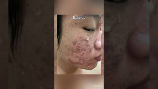 1 year before after severe acne isotretinoin journey jerawat isotretinoin acne [upl. by Hospers]