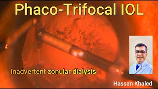 Phacoemulsification and Trifocal IOL Inadvertent Zonular Dialysis [upl. by Thurston]