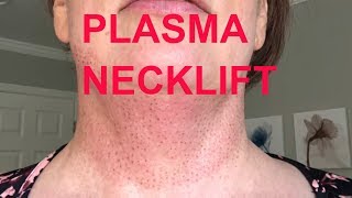 LIVE Neck lift without surgery  My Plasma Fibroblast Necklift 2 [upl. by Leuqcar]