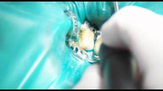 Endodontische Keimreduktion [upl. by Trudi]