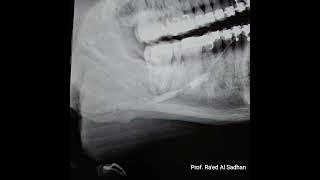 Submandibular Sialography of a Sialolith stone moving in the duct and causing partial obstruction [upl. by Faye]